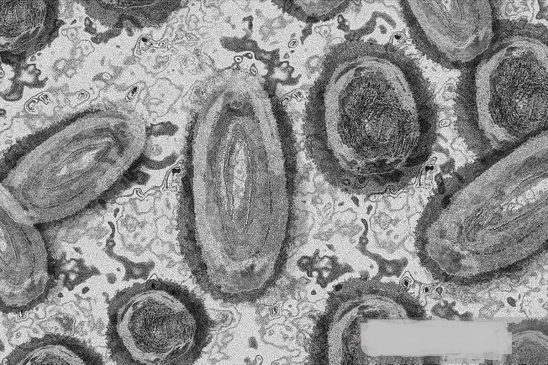 Mpox di Australia Melonjak 570 Persen